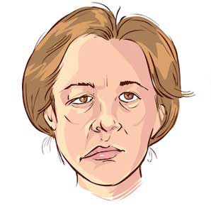 Myasthenia Gravis Treatment in Hyderabad