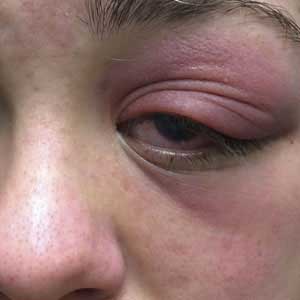 myasthenia gravis treatment