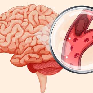 brain stroke treatment in Hyderabad